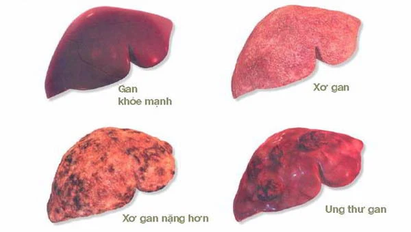 Các dấu hiệu nhận biết ung thư gan.