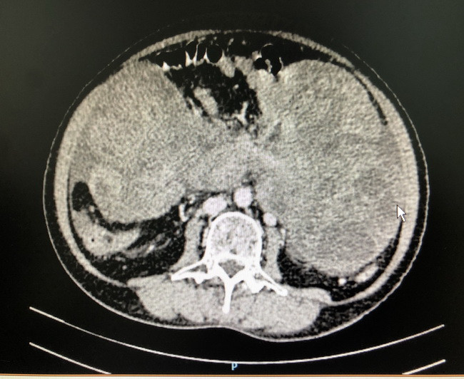 Hình chụp CT khối u chiếm gần hết ổ bụng bệnh nhân. Hình chụp CT khối u chiếm gần hết ổ bụng bệnh nhân.