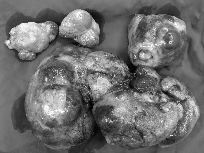 Khối u " khổng lồ" nặng 3kg được lấy ra khỏi người bệnh. Khối u " khổng lồ" nặng 3kg được lấy ra khỏi người bệnh.