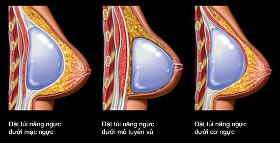 Chị em nâng ngực phải hiểu để tránh sự cố.