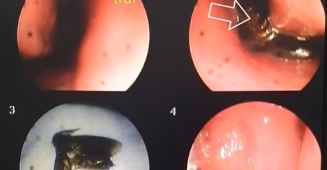 Côn trùng ở trong sống mũi trái.