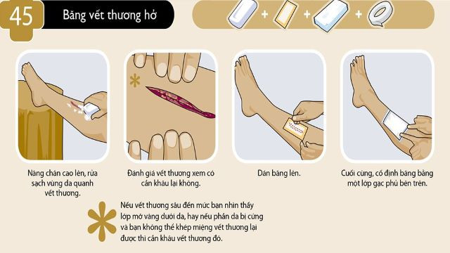 Cách sơ cứu vết thương khi bị chảy máu (ảnh minh họa).