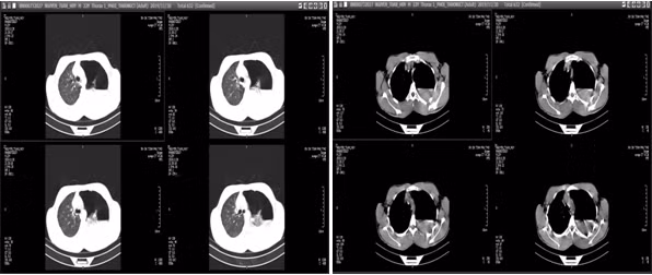 Phim chụp cắt lớp vi tính (BVCC).