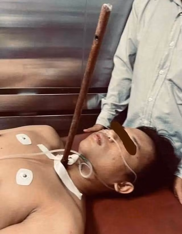 Nam nhân bị mũi tên bắn vào cổ (Ảnh: BVCC).