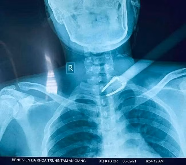 Hình X Quang. (Ảnh: BVCC).