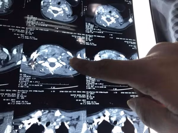 Hình ảnh phim chụp (BVCC).