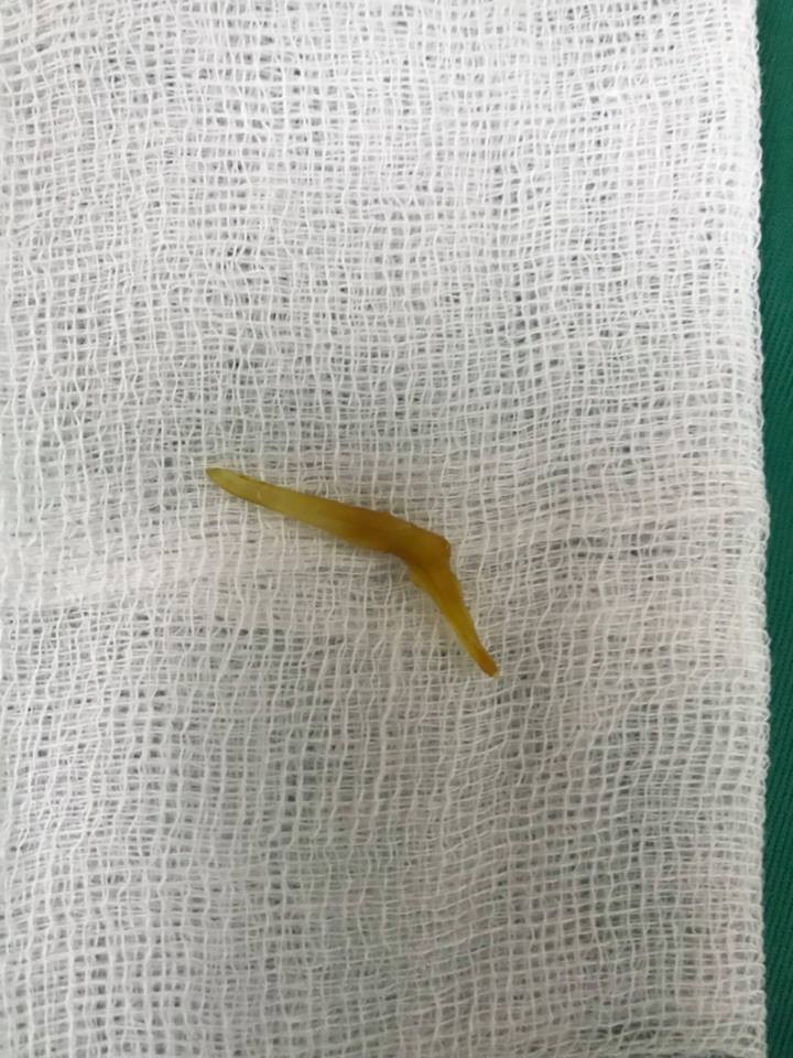 Xương cá lấy ra từ ruột bệnh nhân.