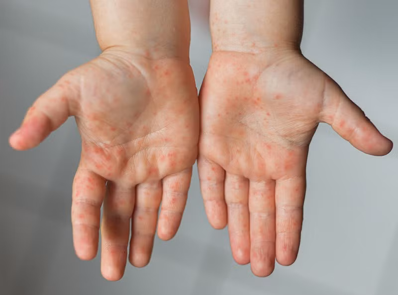 Gia tăng ca mắc bệnh tay chân miệng tại TPHCM