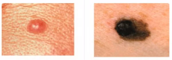 Dấu hiệu nhận biết nốt ruồi ung thư so với nốt ruồi thường