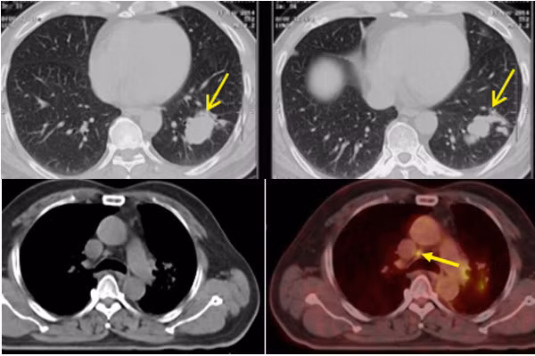 Hình ảnh khối u ở phổi bệnh nhân V. (2 ảnh trên) và hình ảnh khối u thu nhỏ sau điều trị.