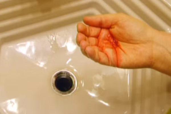 Ông V. không hề đau đớn nhưng ho ra máu, là biểu hiện của ung thư phổi giai đoạn muộn