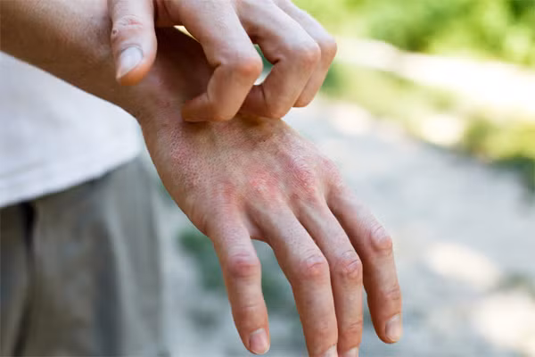 Ngứa ngáy trên da có thể là biểu hiện của bệnh nhân nhiễm nCoV. Ảnh minh họa: Irish skin.