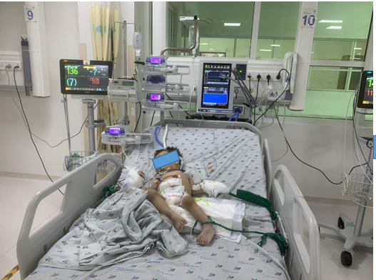 Bé trai bị viêm ruột biến chứng tắc ruột, thủng ruột, được điều trị tích cực tại khoa hồi sức ngoại. (Ảnh: BVCC)