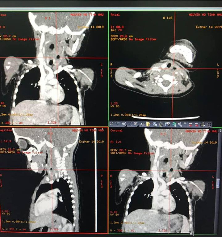 Hình ảnh CTscan, khối u lan xuống khoang cổ sâu bên trái, giữa tuyến giáp trái và các mạch máu lớn vùng cổ, nhiều khối áp xe (Ảnh BVCC). Hình ảnh CTscan, khối u lan xuống khoang cổ sâu bên trái, giữa tuyến giáp trái và các mạch máu lớn vùng cổ, nhiều khối áp xe (Ảnh BVCC).
