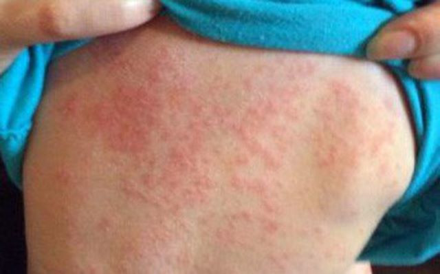 Tiêm phòng sởi là biện pháp hữu hiệu. Tiêm phòng sởi là biện pháp hữu hiệu.