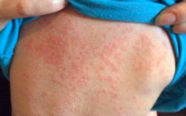 Tiêm phòng sởi là biện pháp hữu hiệu.