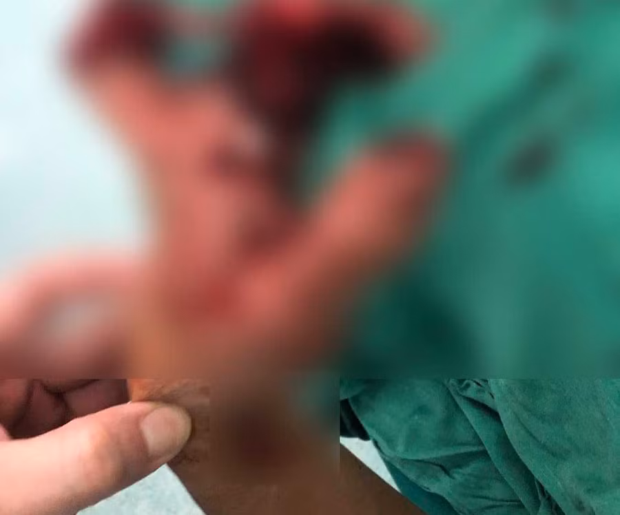 Nạn nhân bị thương dập nát bàn tay do chơi pháo vào dịp Tết (Ảnh: BVCC)