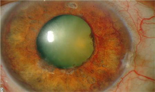 Biến chứng mắt do đái tháo đường. Biến chứng mắt do đái tháo đường.