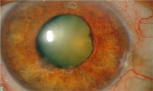 Biến chứng mắt do đái tháo đường.