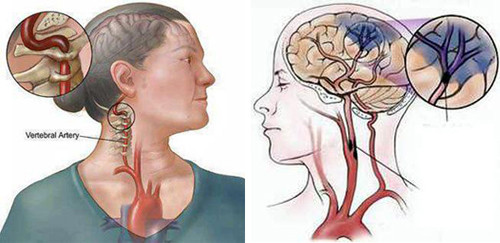 Bệnh đột quỵ có thể phòng ngừa.