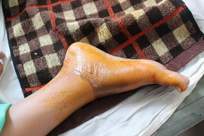 Chân của học sinh bị điện giật gây bỏng.