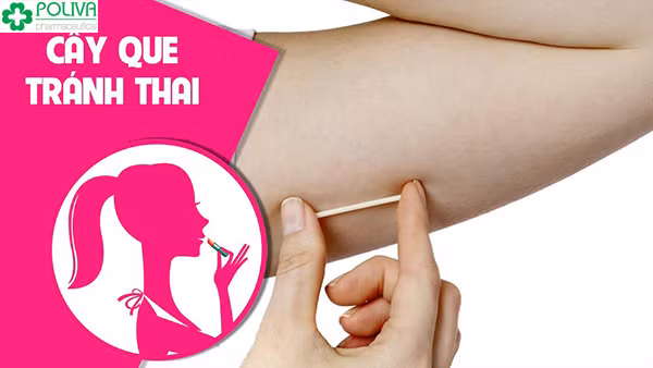 Cấy que tránh thai được nhiều phụ nữ tin dùng.