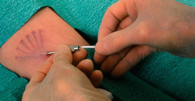 Một số người không nên cấy que tránh thai (Ảnh IT). Một số người không nên cấy que tránh thai (Ảnh IT).