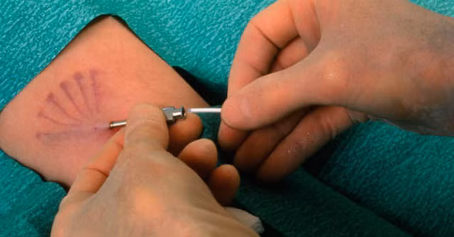 Một số người không nên cấy que tránh thai (Ảnh IT).