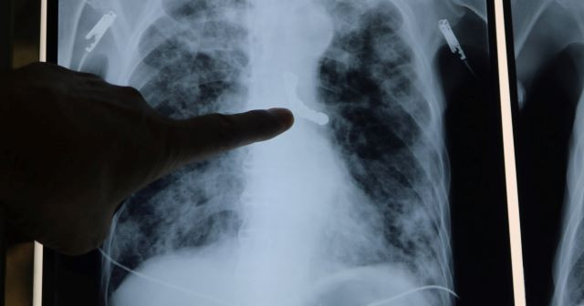 Phim chụp dị vật trong phế quản (BVCC).