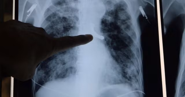 Phim chụp dị vật trong phế quản (BVCC).