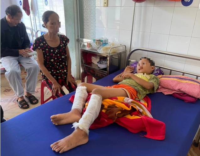 Cháu T. cả hai chân sau khi bị cha mình dùng xăng và rơm đốt.