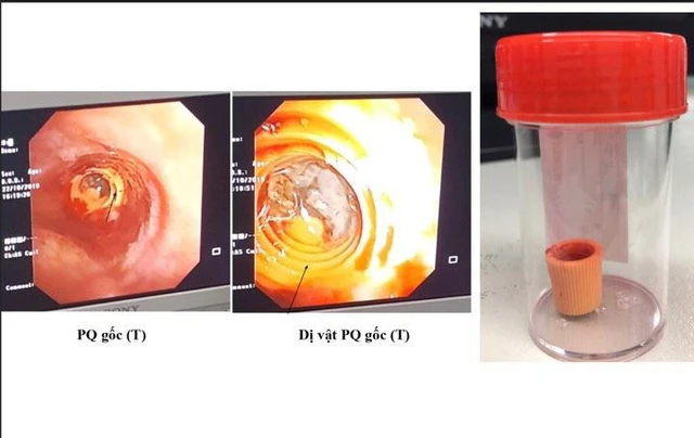 Dị vật được lấy ra từ phế quản (BVCC).