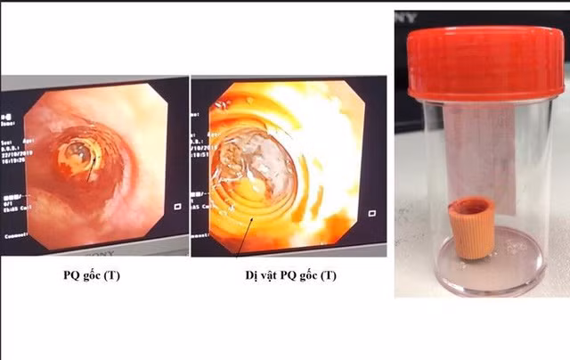Dị vật được lấy ra từ phế quản (BVCC).
