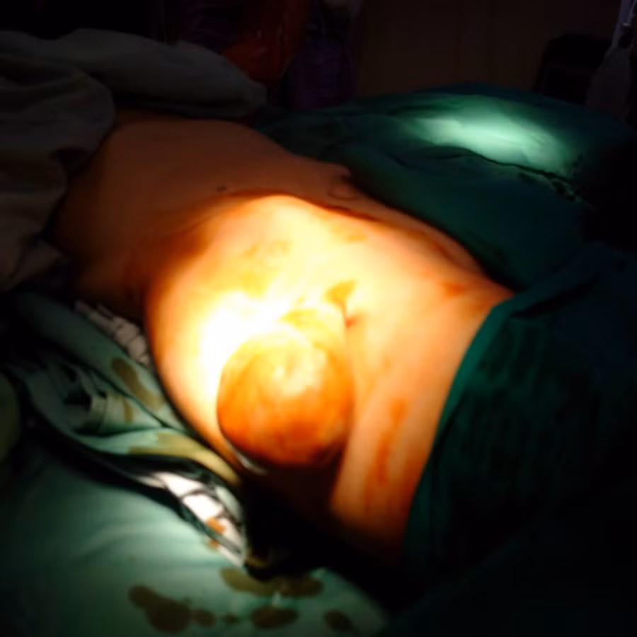 Khối u mỡ gây bất tiện cho người bệnh