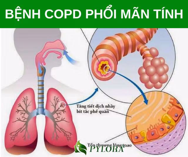 Dấu hiệu và cách phòng tránh bệnh phổi tắc nghẽn mãn tính