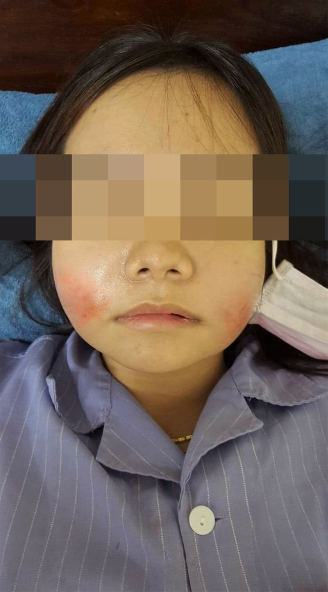 Bệnh nhân bị sưng tấy sau khi tiêm filler (BVCC).