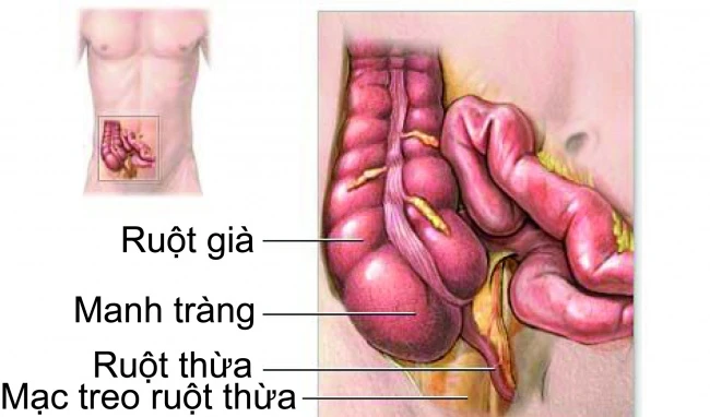 Mắc viêm ruột mạn tính vì cách ăn uống hàng ngày (Ảnh MH).