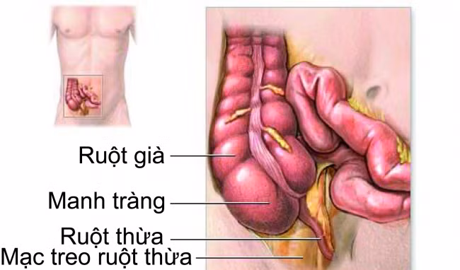 Mắc viêm ruột mạn tính vì cách ăn uống hàng ngày (Ảnh MH).