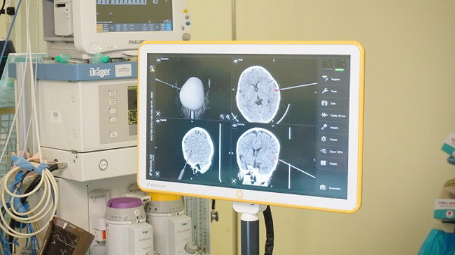 Hệ thống máy định vị 3D giúp xác định chính xác vị trí khối u não so với vị trí của hộp sọ. Hệ thống máy định vị 3D giúp xác định chính xác vị trí khối u não so với vị trí của hộp sọ.