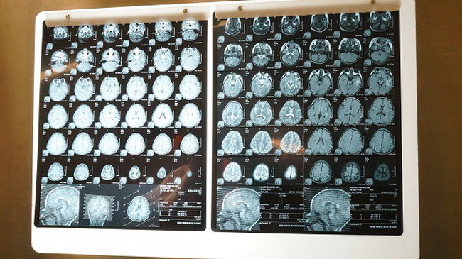 Phim chụp vùng đầu của bệnh nhi G.V. Phim chụp vùng đầu của bệnh nhi G.V.