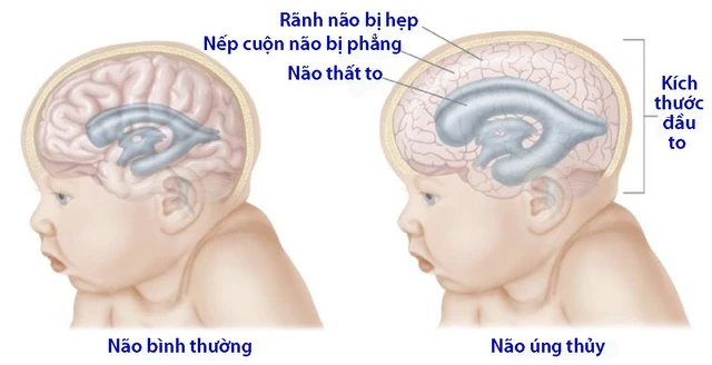 Bệnh não úng thủy.