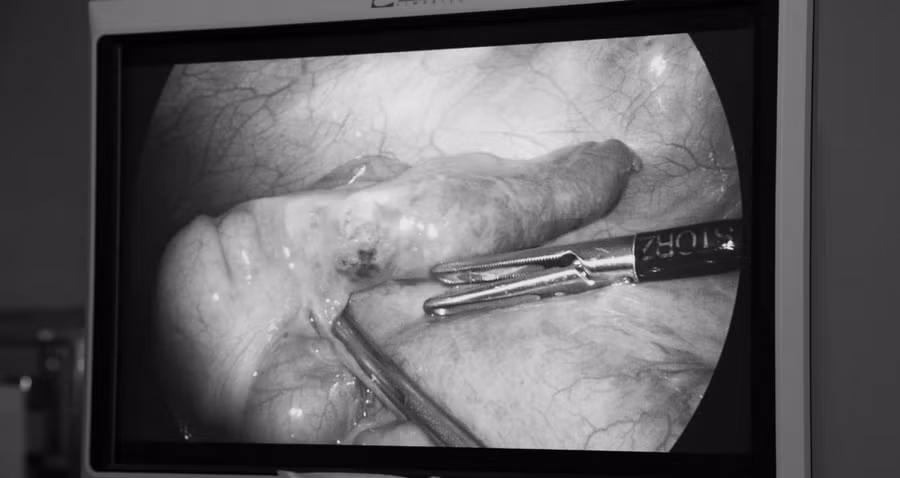 Xương cá xuyên thủng ruột gây viêm ruột thừa.