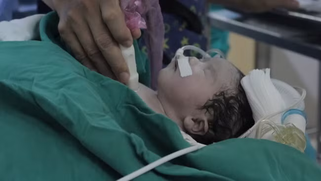 Bé sơ sinh được can thiệp cấp cứu phá vách liên nhĩ bằng bóng qua da (Ảnh:BVCC) Bé sơ sinh được can thiệp cấp cứu phá vách liên nhĩ bằng bóng qua da (Ảnh:BVCC)