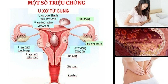 Dấu hiệu u xơ cơ tử cung (Ảnh MH).