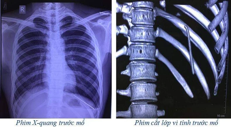 Phim chụp hình ảnh chiếc đinh ở khoang màng phổi.