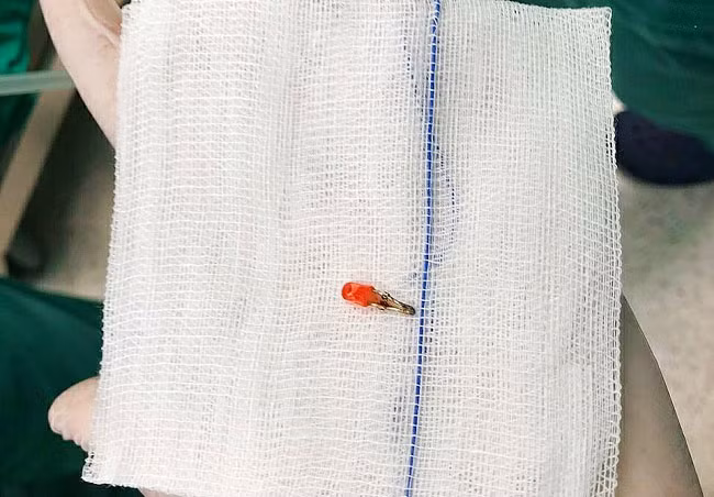 Dị vật đèn LED nhựa gắp ra khỏi bệnh nhi (Ảnh: BVCC).