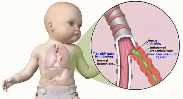 Trẻ bị nặng sẽ có dấu hiệu sốt cao, nôn trớ.