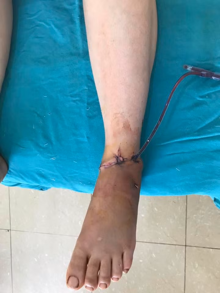 Nối thành công bàn chân gần đứt cho một giáo viên mầm non