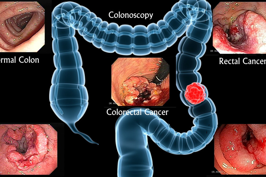 Cẩn trọng với ung thư đại tràng. Cẩn trọng với ung thư đại tràng.