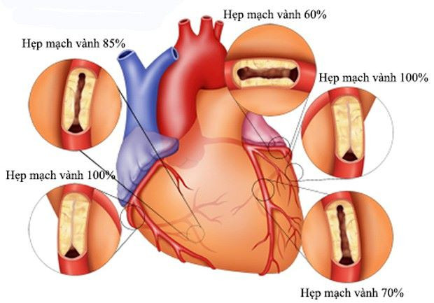 Bệnh động mạch vành cần được chữa trị kịp thời (Ảnh MH). Bệnh động mạch vành cần được chữa trị kịp thời (Ảnh MH).